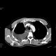 Malposition of central venous line, infusion in mediastinum: CT - Computed tomography